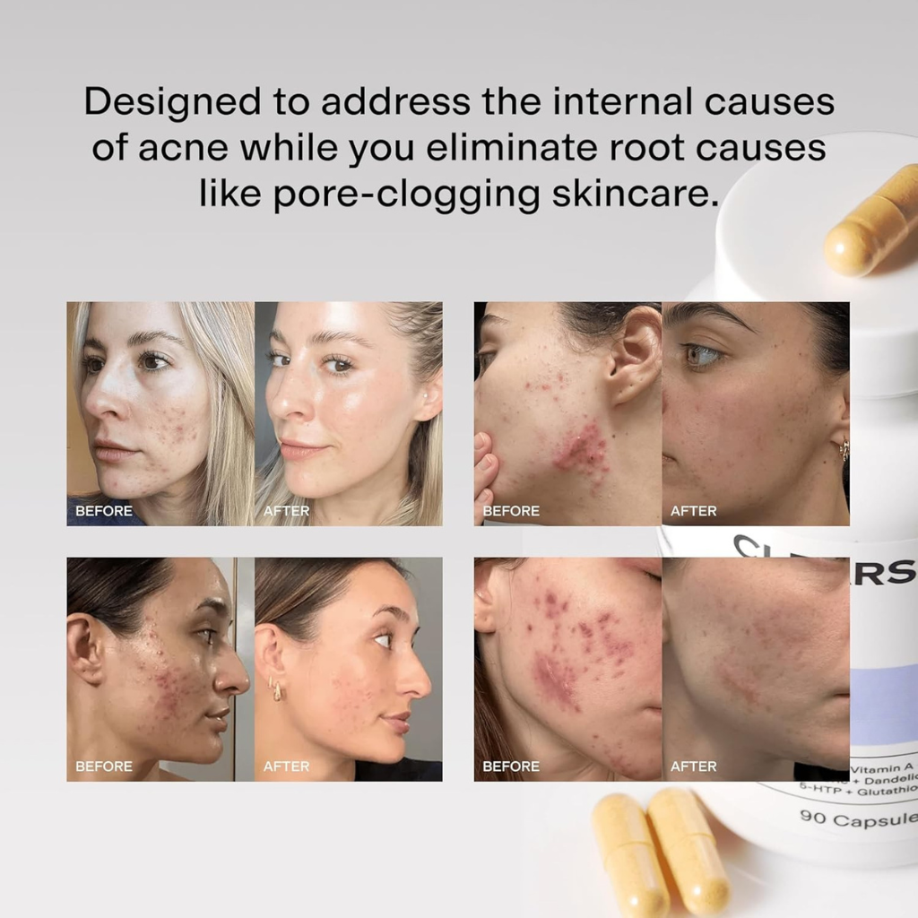 DIM Complex 9-in-1 - Hormonal Acne Clear Skin